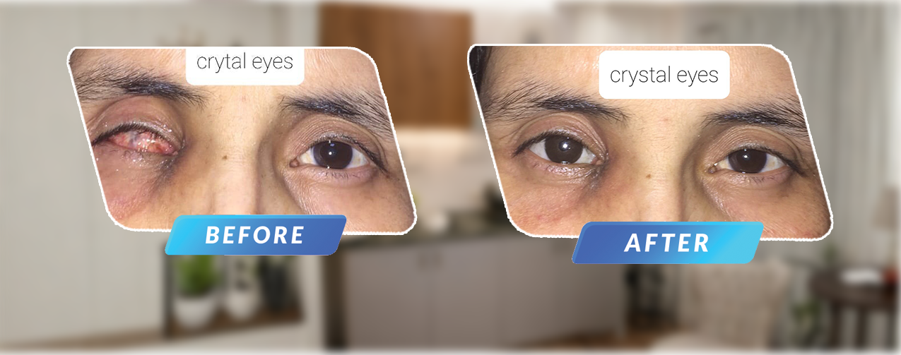 artificial eye before-after