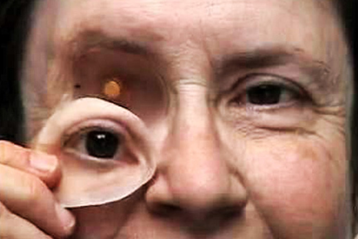 Orbital Prosthesis 